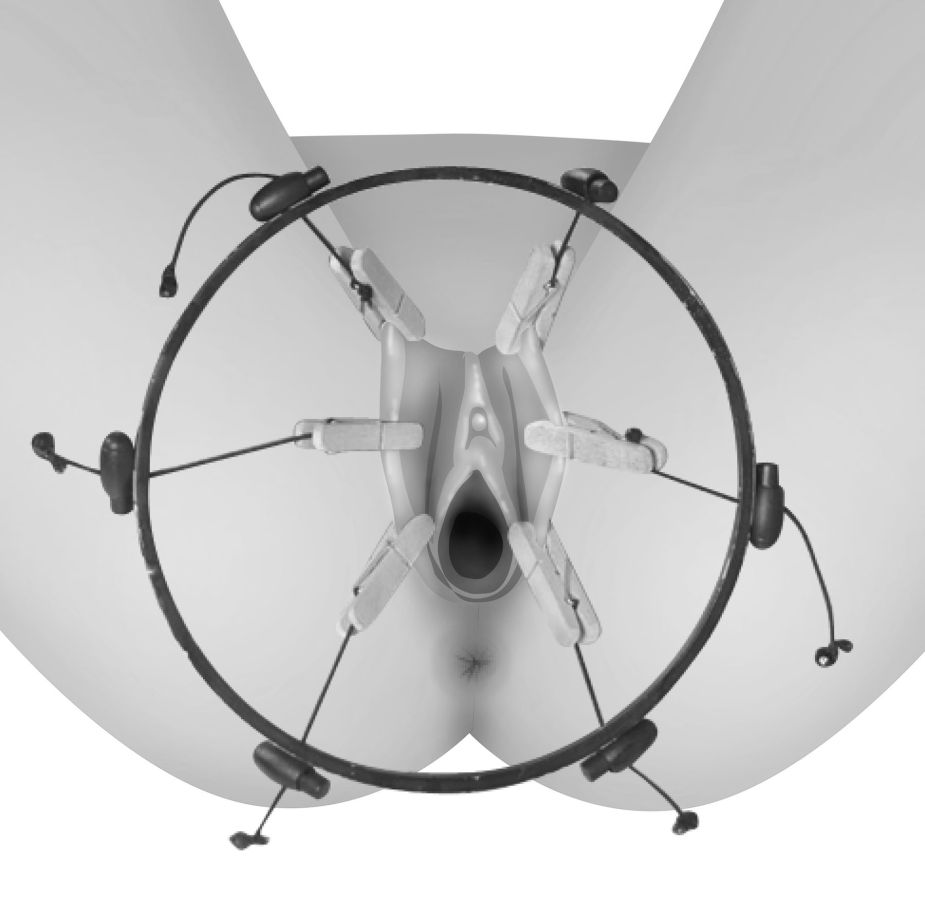 Adjustable labia spreaders ring with clothespin clamps